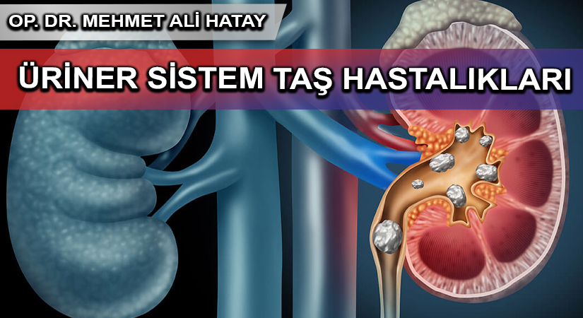 ÜRİNER SİSTEM TAŞ HASTALIKLARI