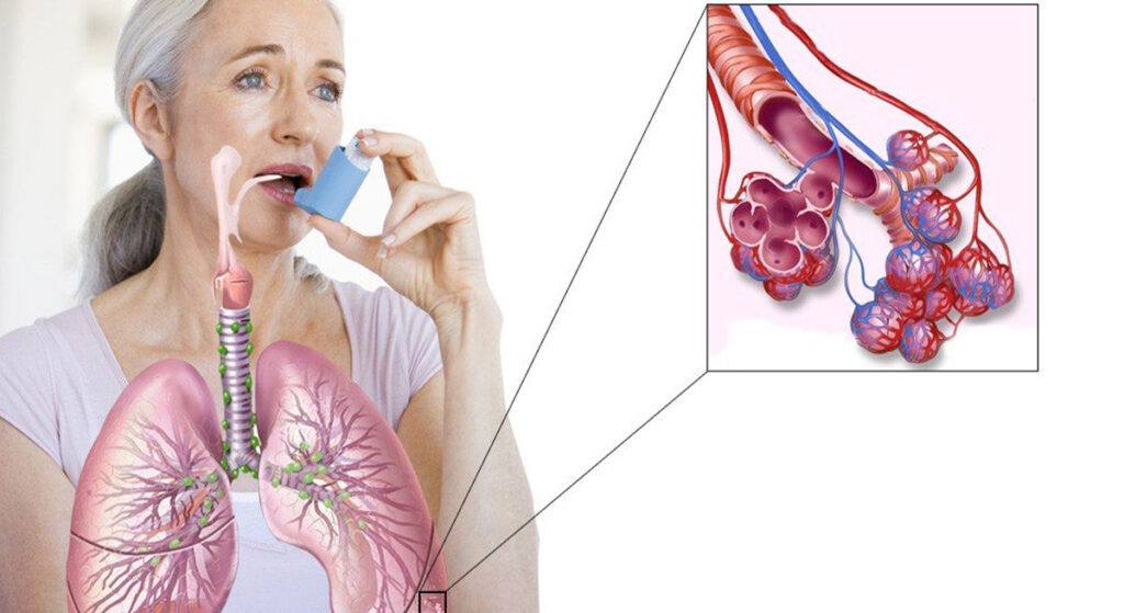 ‘HAVA KİRLİLİĞİ ASTIMI ARTIRIYOR’