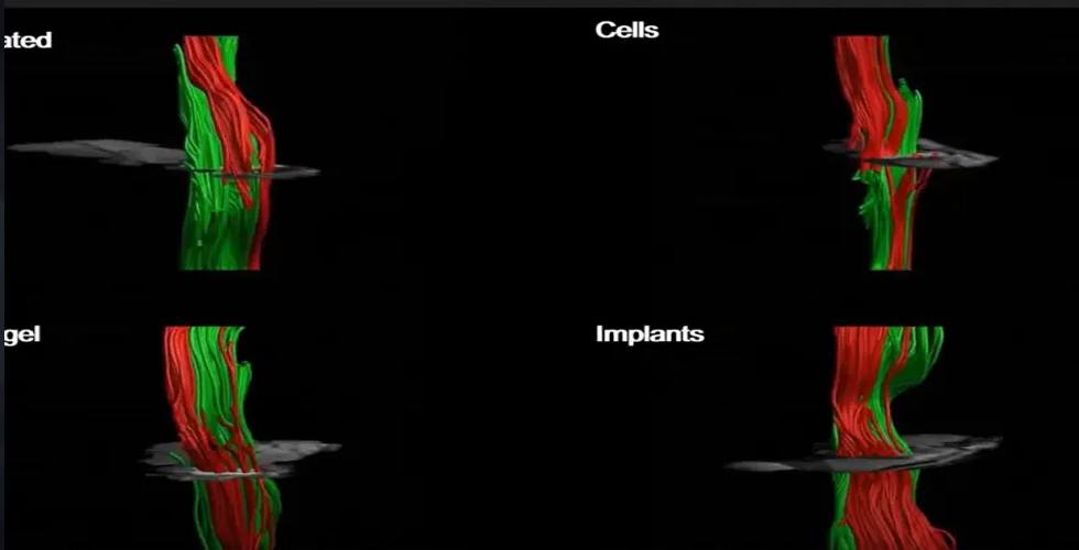 Felçliler Artık Yürüyebilecek