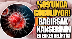 BAĞIRSAK KANSERİNİN EN BELİRĞİN BELİRTİSİ NEDİR?  %89’UNDA BU BELİRTİ GÖRÜLÜYOR