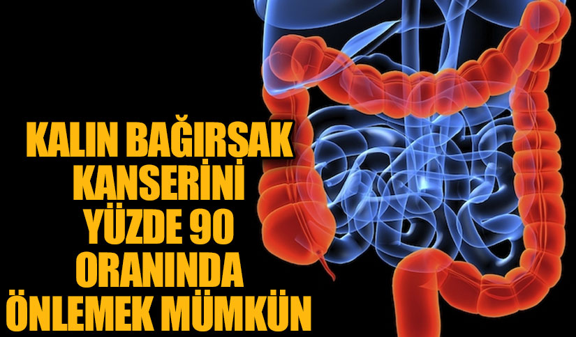 Kalın Bağırsak Kanserini Yüzde 90 Oranında Önlemek Mümkün